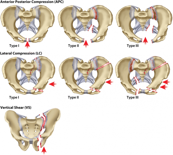 Pelvic Fractures - Physiopedia