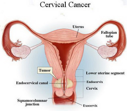 File:Cervical-Cancer-Picture.jpg