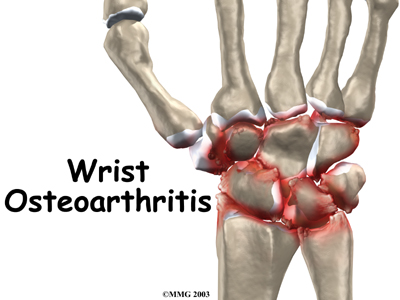 File:Wrist osteoarthritis intro01.jpg