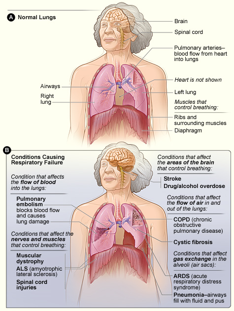 respiratory distress syndrome
