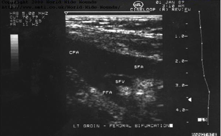 File:Longitudinal scan of femoral bifurcation.png