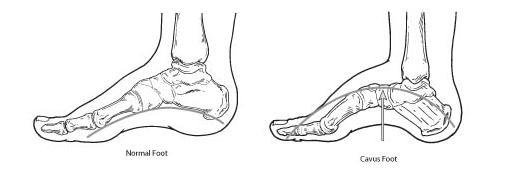 cavus foot support