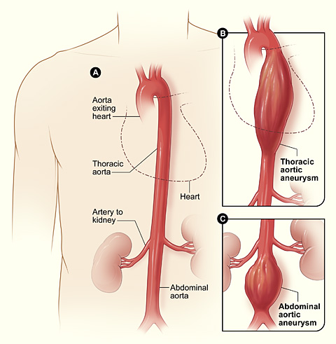 File:Aortic aneurysm.jpg