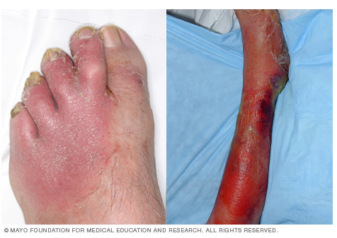 File:Cellulitis Mayo.PNG