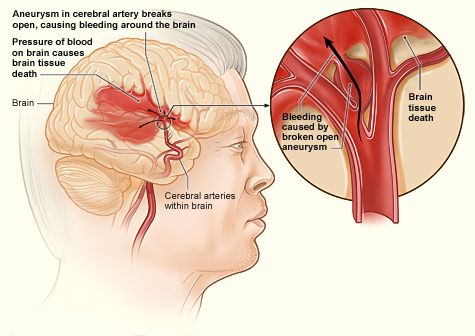 brain hemorrhage diagram