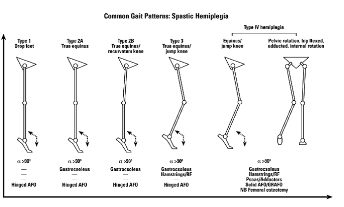 File:Common Gait patterns spastic Hemiplegia.png