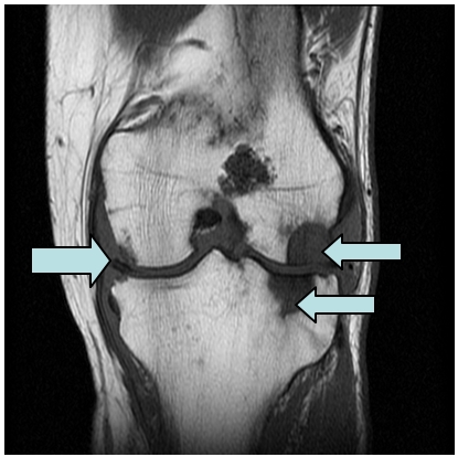 File:MRI for knee OA.jpg