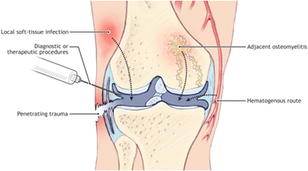 how drain fluid knee from (Infectious) Physiopedia  Septic Arthritis