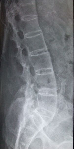 File:Ankylosing spondylitis lumbar spine.jpg