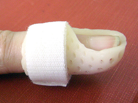 File:Mallet finger splint (thermoplastic).jpg