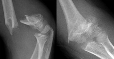 icd 10 code closed supracondylar fracture elbow