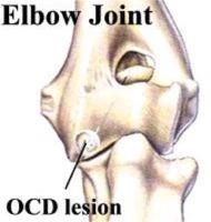 Elbow joint OCD lesion.jpg