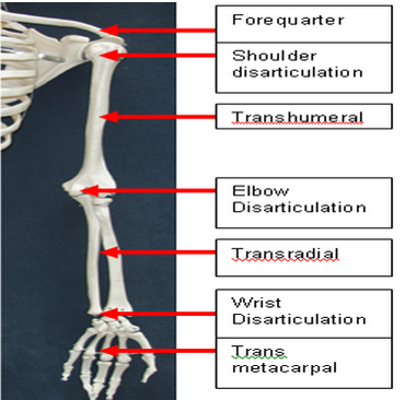 Levels of amputation - upper limb