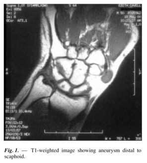 File:Radial artery aneurysm.JPG