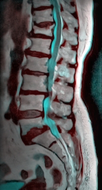 Introduction to Spinal Orthotics - Physiopedia