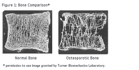 File:Bone Comparison of Healthy and Osteoporotic Vertibrae.png