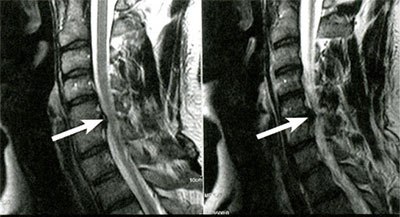File:Cervical spine mri.jpg