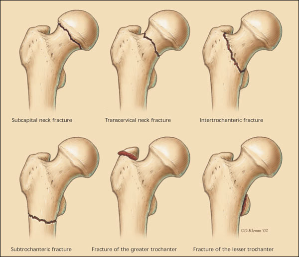 File:Figure1 hip fracture.jpeg