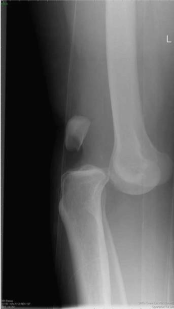 Knee dislocation.jpg