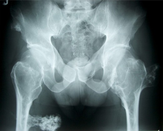 File:Multiple osteosarcomas.jpg
