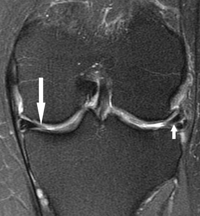 File:MRI for meniscus tear.jpg