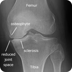 Radiograph for knee OA.jpg