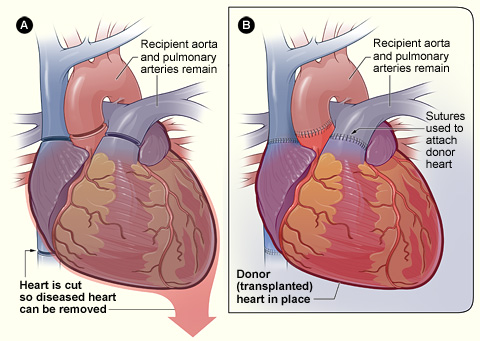 File:Heart transplant NIH.jpg
