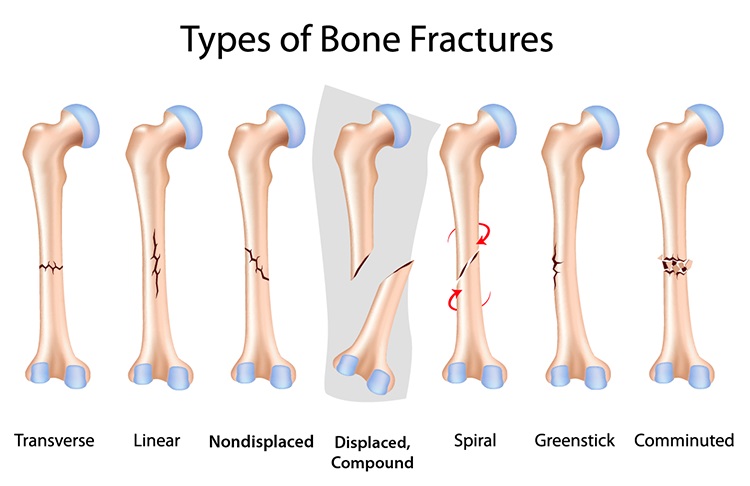 File:Types of fractures.jpg