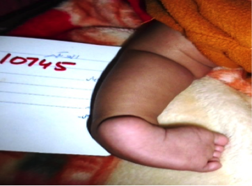 File:Case Study- Idiopathic Unilateral Clubfoot 2.png