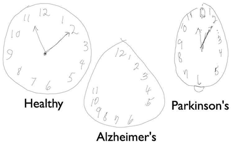 File:Clock-drawing-alzheimers-test.jpg
