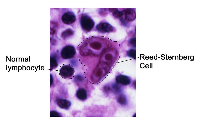 File:Reed-Sternberg cell.jpg