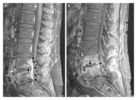File:Osteomyelitis spine.jpg