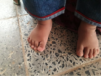 File:Case Study-Idiopathic Bilateral Clubfoot 4.png