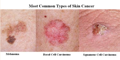 Skin Cancer.png