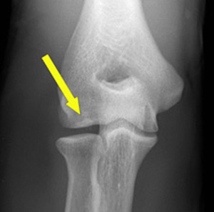 Arrow points to osteochondral flake in capitullum