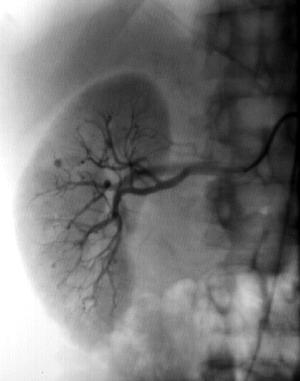 File:PAN kidney.jpg