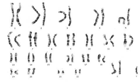 File:Klinefelter's Syndrome XXY DNA karyotype.jpg