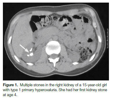 File:Calcified kidney.jpg