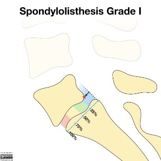 spondylolisthesis exercises to avoid