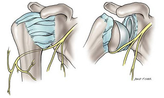 Figure 1. Depiction of the axillary nerve as it is stretched across the humeral head during dislocation.