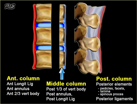 Lumbar Spine Fracture - Physiopedia