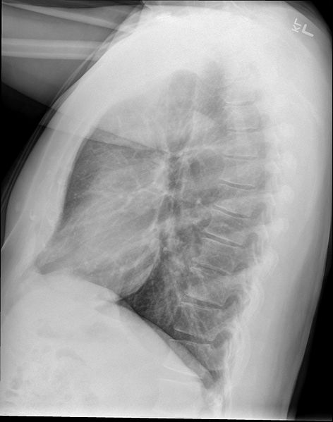File:472px-Chest x-ray - lateral view.jpg