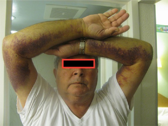 File:Bruised arms.jpg