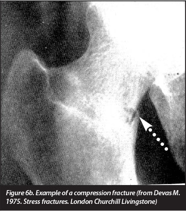 File:Femoral stress fracture compression.jpg