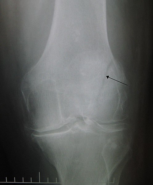 File:Patella fracture.JPG