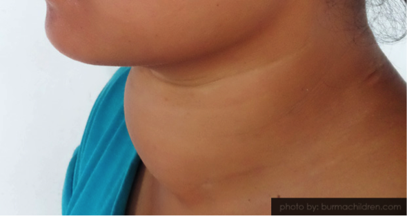 File:Goiter2.png
