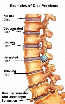 Lumbar Spine: What It Is, Anatomy & Disorders