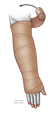 Lymphedema Compression Garments - Physiocare