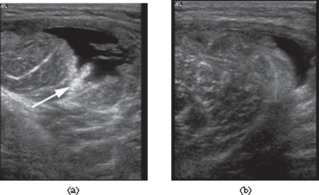 File:Contusion ultrasound imaging.jpg