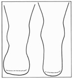 Pre-Fitting Management of the Patient with a Lower Limb Amputation ...